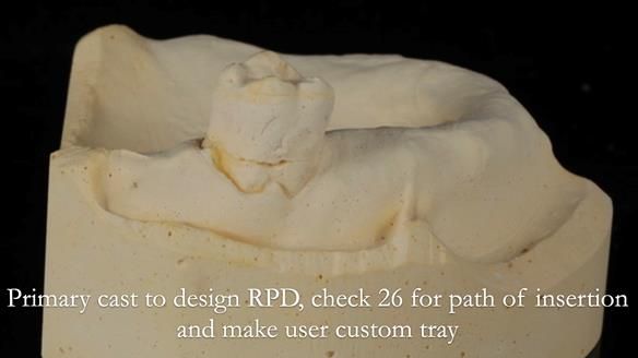 Finlay's Newsletter 58 Gasket upper partial denture for Zoe