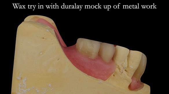 Finlay's Case Study Newsletter 40 - Immediate Mk 1 RPD to Definitive Mk 2 RPD - full protocol