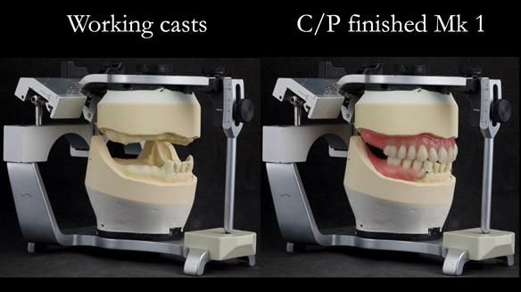 Newsletter 52 Managing Jo’s failing dentition with extractions and Mk 1/Mk 2 complete upper dentures and lower partial dentures FULL PROTOCOL