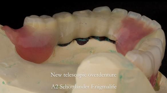 Newsletter 76: Jackie’s case – Telescopic overdenture & precision RPD (the tricky truth!)