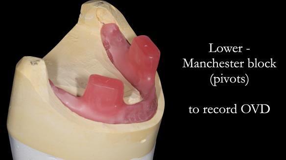 Replacing Madeline’s Complete denture FULL PROTOCOL