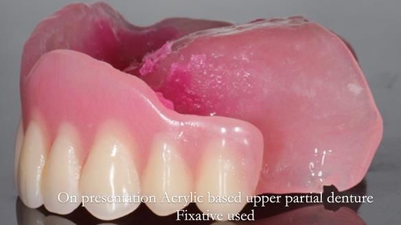 Finlay's Newsletter 58 Gasket upper partial denture for Zoe
