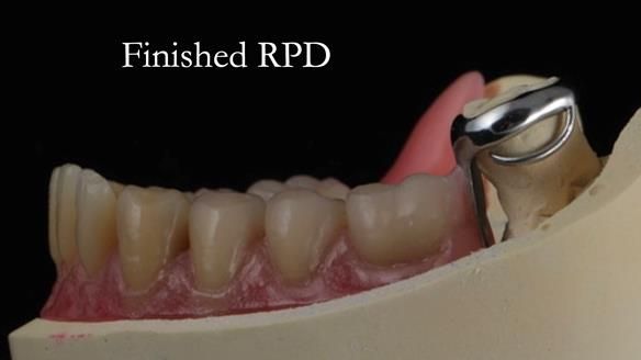 Finlay's Newsletter 59 Ultra hard partial dentures made for Gill