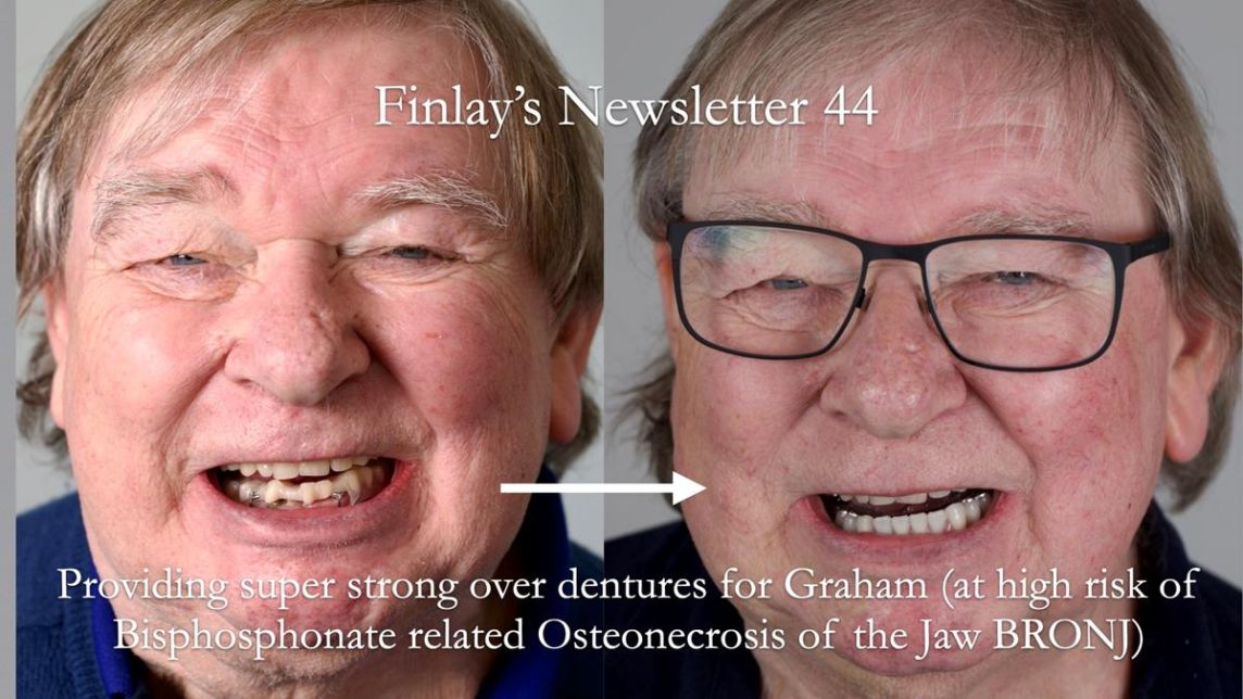 Newsletter 44 - extreme removable prosthodontics – engineering a super-strong and ultra-thin over denture