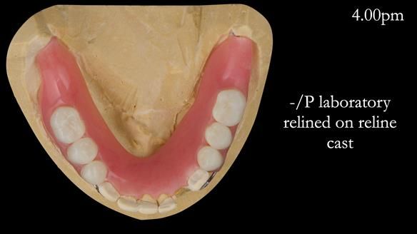 Newsletter 52 Managing Jo’s failing dentition with extractions and Mk 1/Mk 2 complete upper dentures and lower partial dentures FULL PROTOCOL