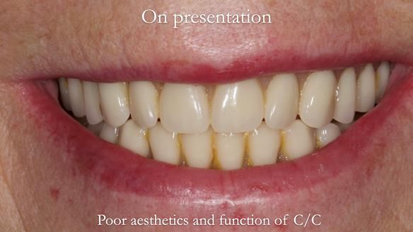 Newsletter 48 Mavis's Complete denture FULL PROTOCOL