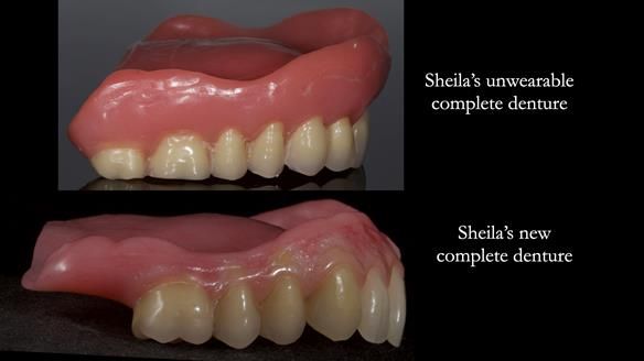 Newsletter 83: Sheila’s Complete Denture Success