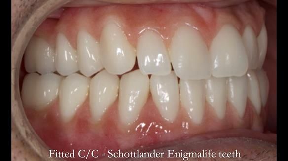 Managing poor implant positioning with complete dentures and Locator attachments - full protocol Newsletter 41