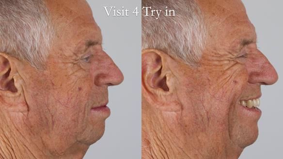 Newsletter 54 case presentation upper complete denture and lower Scandinavian designed hygienic partial denture for David