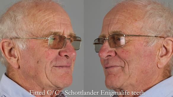 Complete denture Class II div 2 deep overbite Newsletter 39