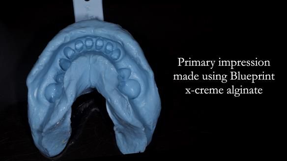 Newsletter 81 - Pam’s Story — how a partial denture changed her life (+ live walkthrough this Thursday)