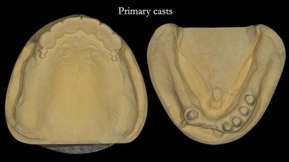 Newsletter 76: Jackie’s case – Telescopic overdenture & precision RPD (the tricky truth!)