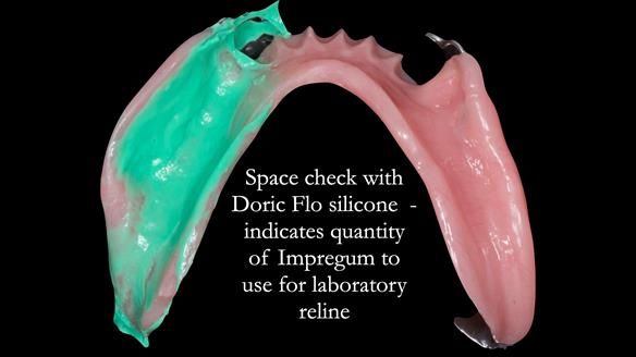 Newsletter 52 Managing Jo’s failing dentition with extractions and Mk 1/Mk 2 complete upper dentures and lower partial dentures FULL PROTOCOL