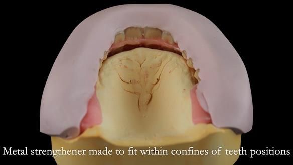 Newsletter 53 showing the making and fitting of ultra life-like dentures for Valena