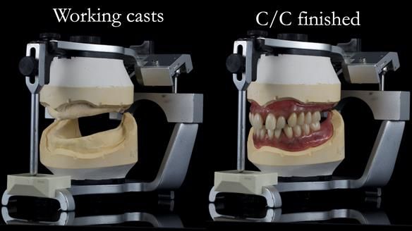 Newsletter 53 showing the making and fitting of ultra life-like dentures for Valena