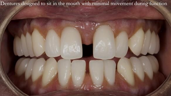 Newsletter 53 showing the making and fitting of ultra life-like dentures for Valena