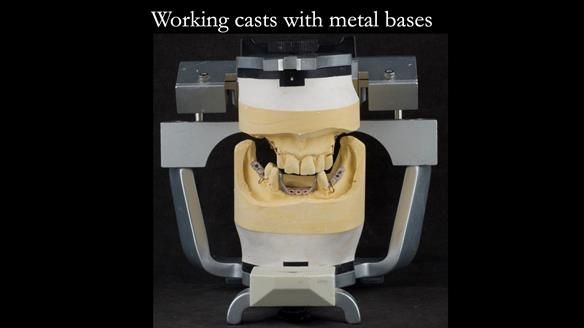 Finlay's Case Study Newsletter 40 - Immediate Mk 1 RPD to Definitive Mk 2 RPD - full protocol