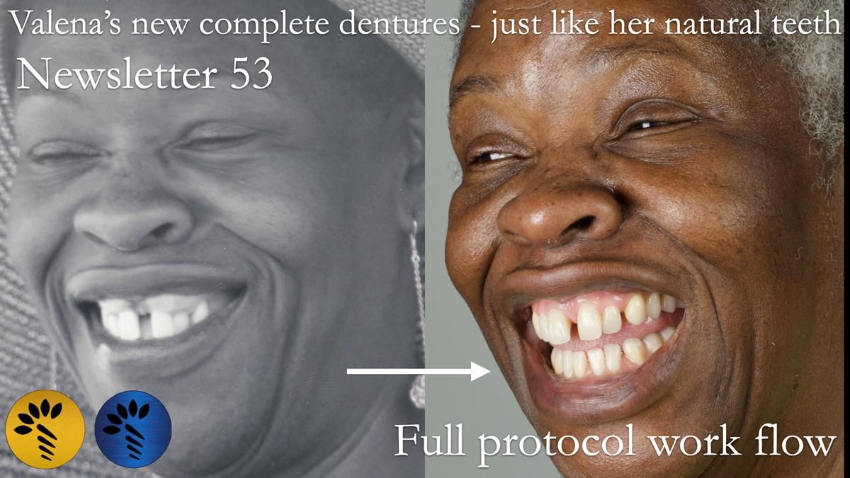 Newsletter 53 showing the making and fitting of ultra life-like dentures for Valena