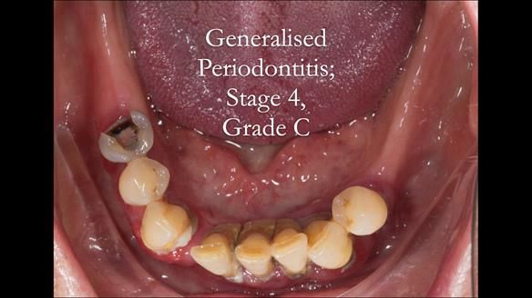 Finlay's Case Study Newsletter 40 - Immediate Mk 1 RPD to Definitive Mk 2 RPD - full protocol