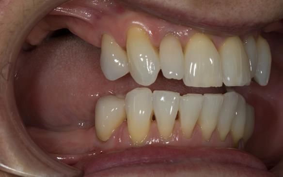 Figure 53 Porcelain fused to zirconia crown crowns incorporating parallel guiding surfaces, ledges and rest seats for the metal based partial dentures - fitted with Fuji plus cement.