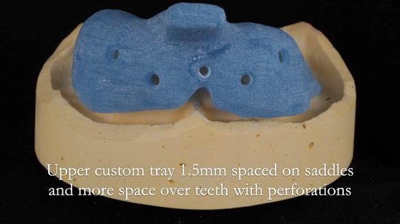 Newsletter 56 showing the making and fitting of a bilateral free end saddle upper removable partial denture (RPD) for patient with pemphigus