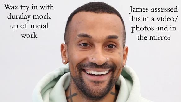 Upper metal base partial denture/occlusal stabilisation splint/obturator - full protocol