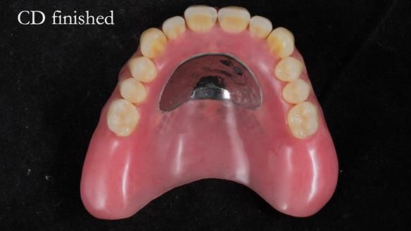 Finlay's Newsletter 62 provision of extractions and metal based complete dentures for Rafique