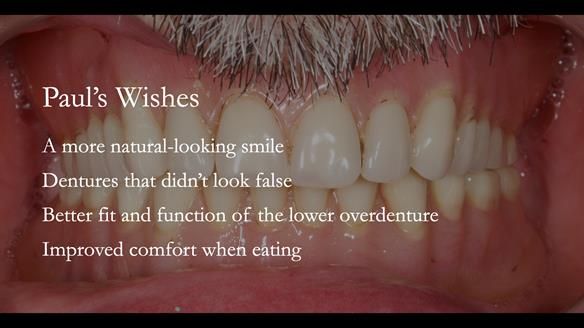 Newsletter 78: What do Clark Gable and a Locator® overdenture have in common?