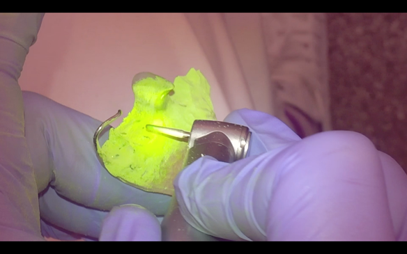 Figure 33 Adjusting the collets with high speed diamond bur to allow full seating of the denture