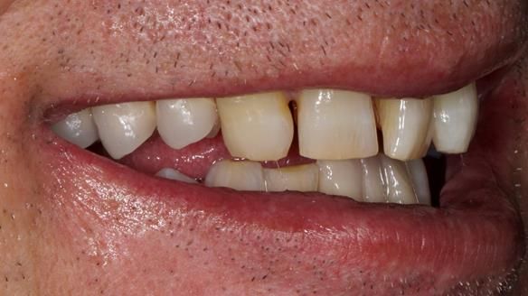 Newsletter 86 Peter the Architect — precision removable partial dentures case study