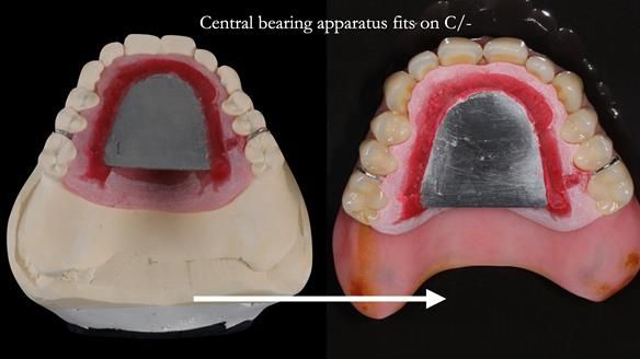 Newsletter 54 case presentation upper complete denture and lower Scandinavian designed hygienic partial denture for David