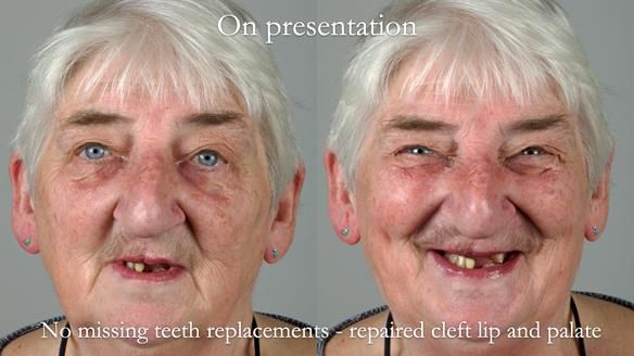 Newsletter 55 Provision of metal based partial dentures for Zephyrine with a repaired cleft lip and palate