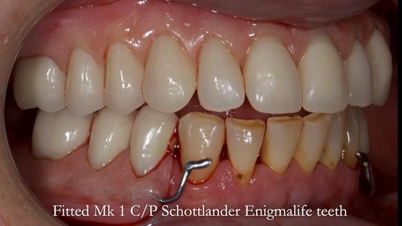 Newsletter 52 Managing Jo’s failing dentition with extractions and Mk 1/Mk 2 complete upper dentures and lower partial dentures FULL PROTOCOL