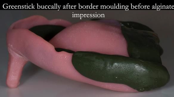 Newsletter 75: Marion’s case - Step-by-step complete denture workflow