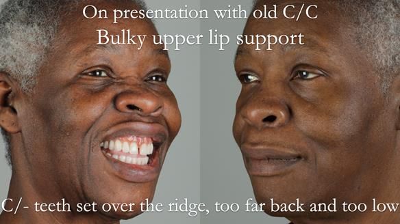 Newsletter 53 showing the making and fitting of ultra life-like dentures for Valena