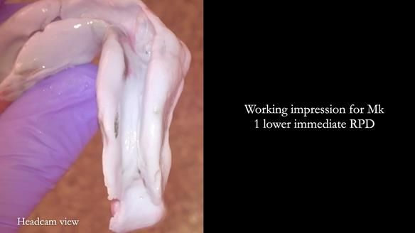 Newsletter 82 Mary - A complete upper and a one-tooth gasket denture