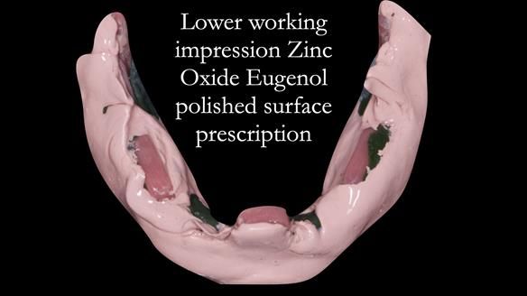 Finlay's Newsletter 62 provision of extractions and metal based complete dentures for Rafique