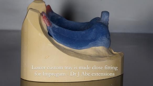 Newsletter 78: What do Clark Gable and a Locator® overdenture have in common?