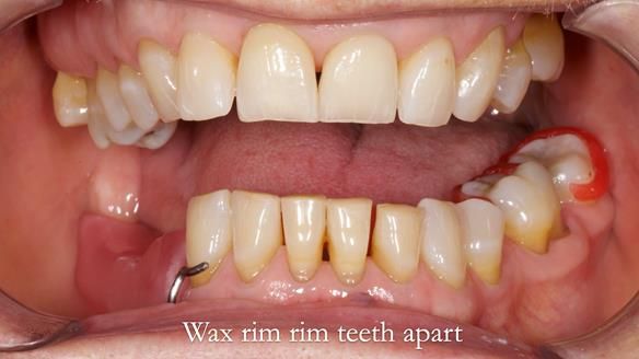 Finlay's Newsletter 61 provision of a lower unilateral free end saddle metal based partial denture for Joyce