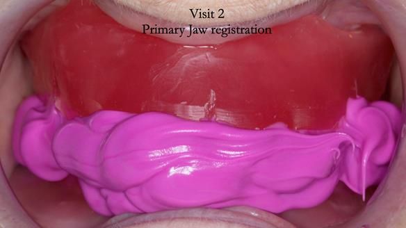 Primary jaw registration - fixed together with futar D