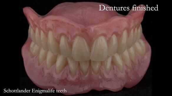 Newsletter 75: Marion’s case - Step-by-step complete denture workflow