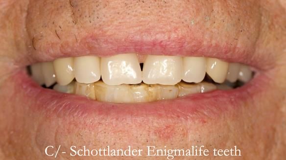Newsletter 54 case presentation upper complete denture and lower Scandinavian designed hygienic partial denture for David