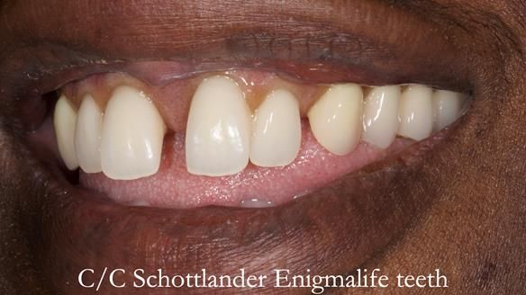 Newsletter 53 showing the making and fitting of ultra life-like dentures for Valena