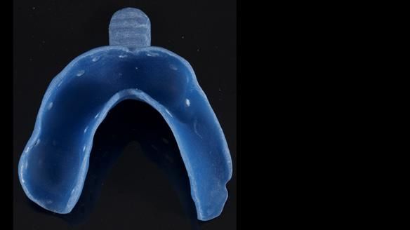 Newsletter 86 Peter the Architect — precision removable partial dentures case study