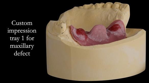 Upper metal base partial denture/occlusal stabilisation splint/obturator - full protocol