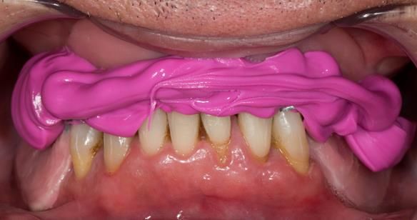 Figure 93 Visit 3 for Mk 2 fabrication. Inter-maxillary registration with central bearing apparatus in the mouth with the maxillary and mandibular parts registered together with futar D bite registration material