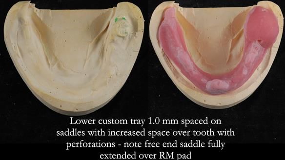 Finlay's Newsletter 59 Ultra hard partial dentures made for Gill