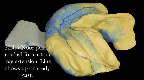 Newsletter 50 Special edition Complete Dentures FULL PROTOCOL