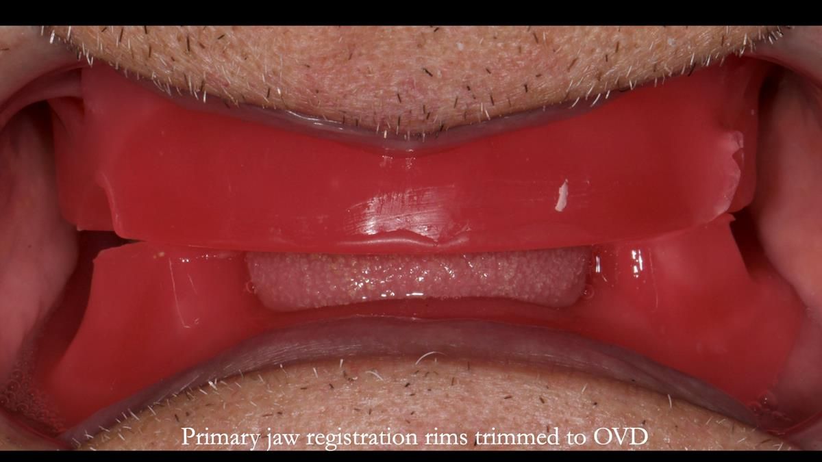 Fin’s Newsletter 88 — Complete dentures - full protocol… he rearranged his own teeth!