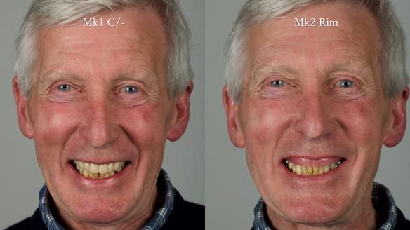 Newsletter 77: Jeremy’s case – immediate complete upper denture